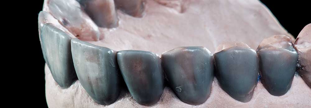 Close up photo of dental wax up.